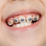 Частые вопросы про установку брекетов детям:  думаем о зубках