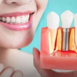 Имплантация зубов:  почему не нужно медлить с процедурой